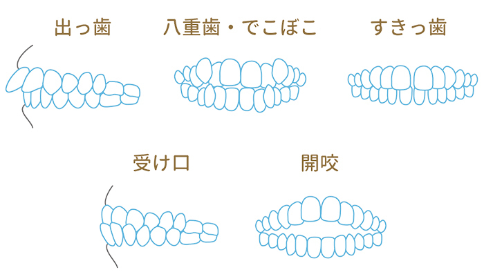 マウスピース矯正ができない症例でも失敗しないために - 浜松市矯正歯科相談室