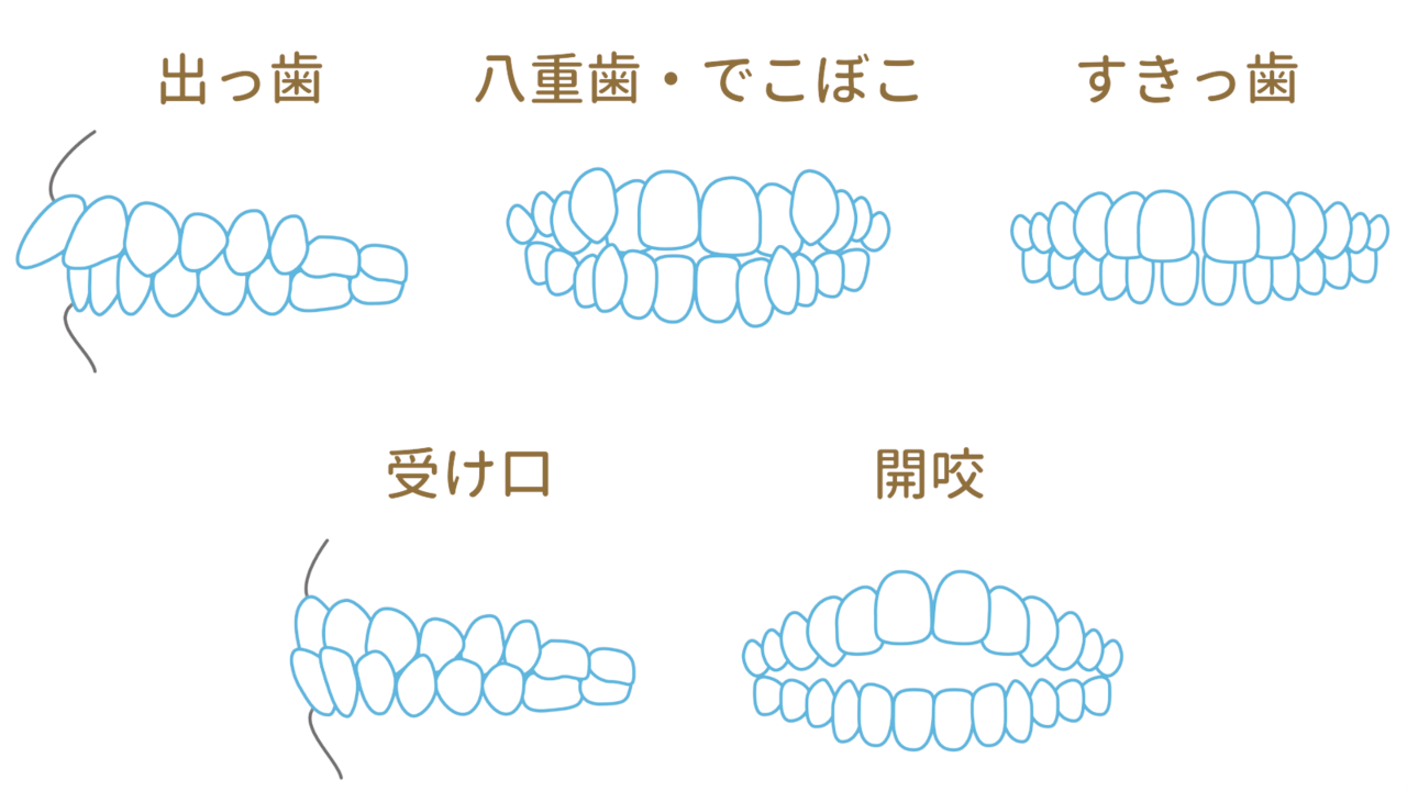 マウスピース矯正ができない症例でも失敗しないために - 浜松市矯正歯科相談室